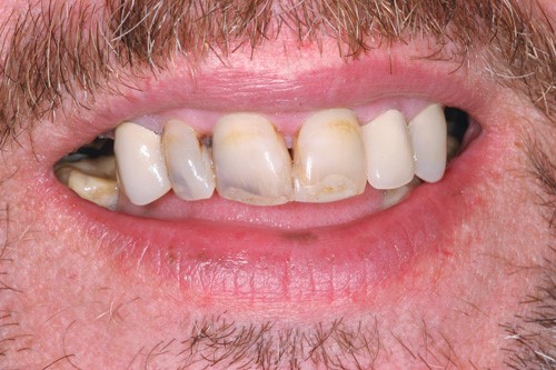 Jaw Registration For 
      Partial Dentures Rochester NY 14607